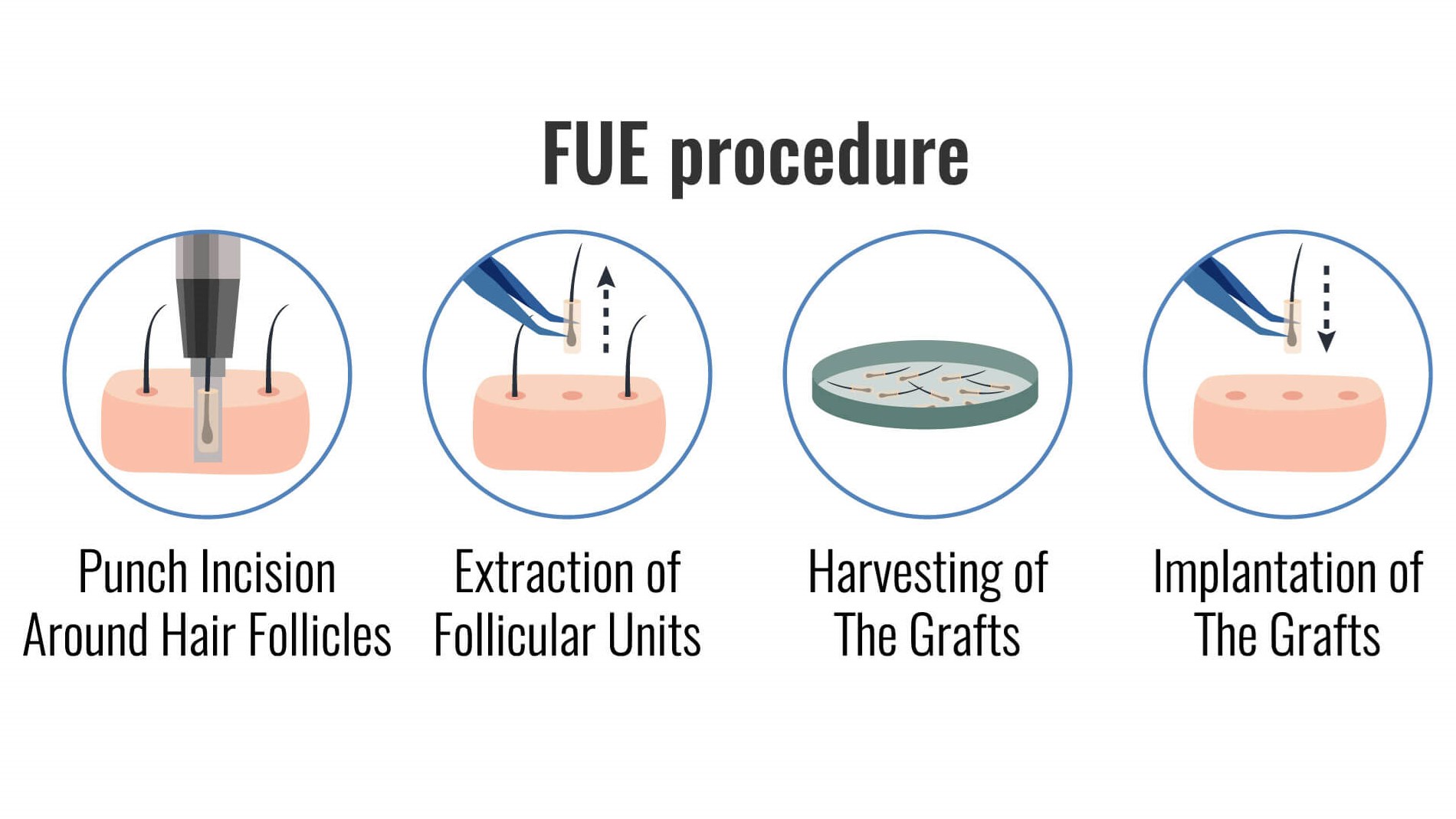 fue hair procedure